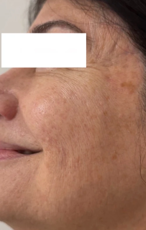 After Microneedling with Exosomes and Micropeel