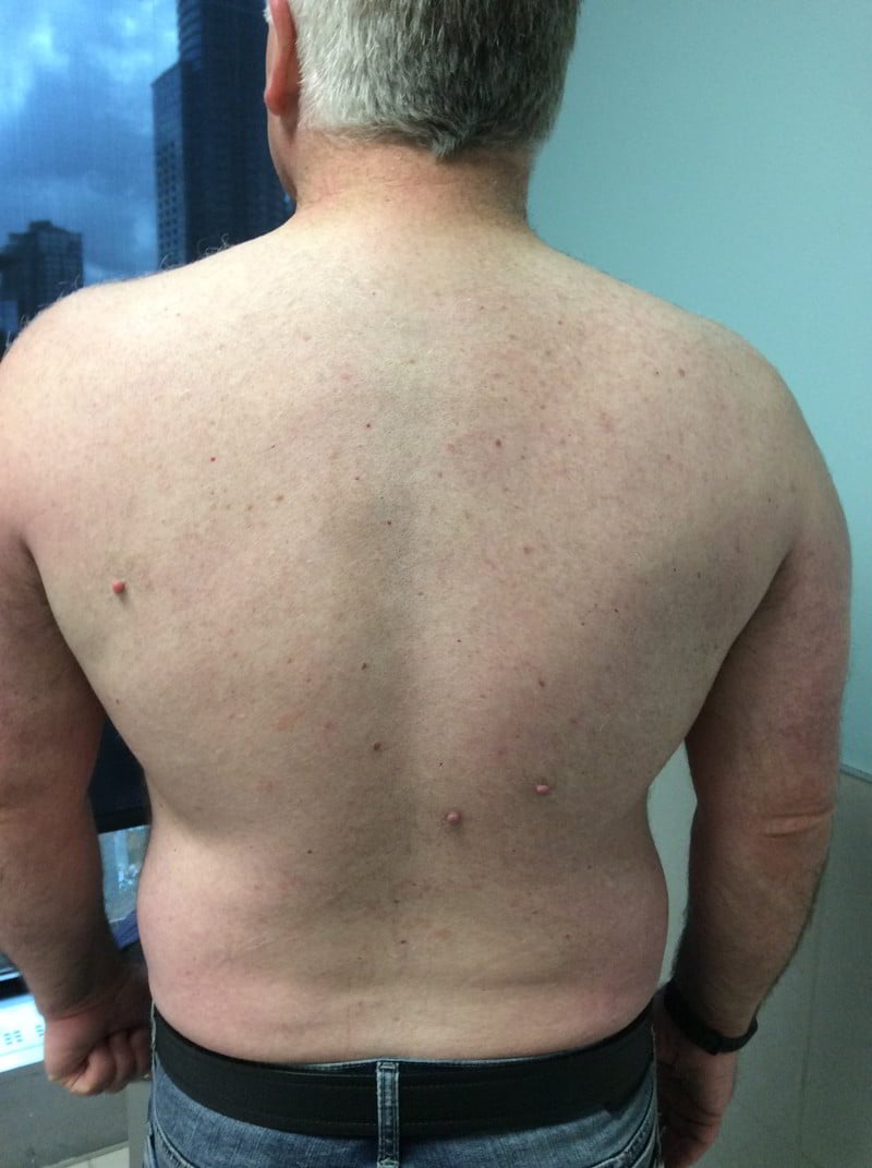 After laser hair removal resurfacing treatment