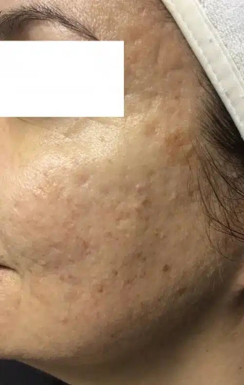 Before Microneedling with Exosomes and Micropeel
