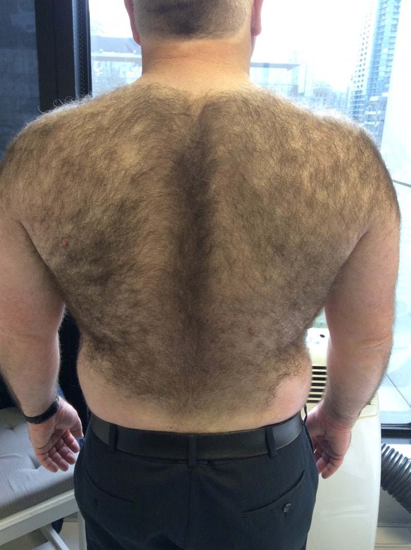 Before laser hair removal treatment showing untreated skin with visible hair growth on the target area