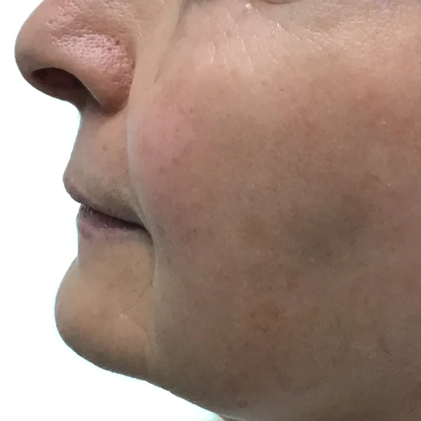 Fotona 4D Facelift for Added Volume After