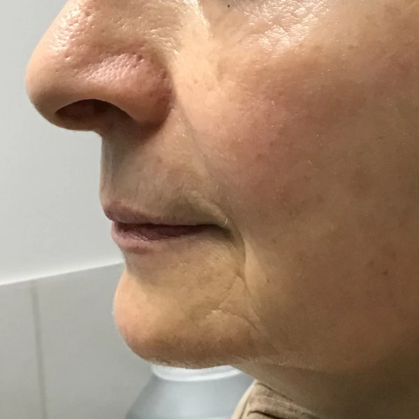 Fotona 4D Facelift for Added Volume Before
