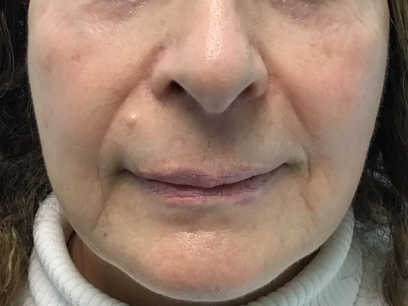 Fotona 4D Facelift for Added Volume After