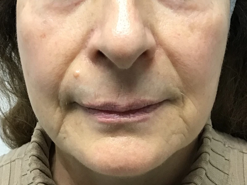 Fotona 4D Facelift for Added Volume Before