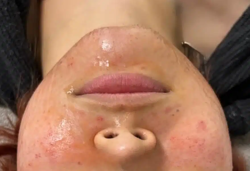 Lipid Mask