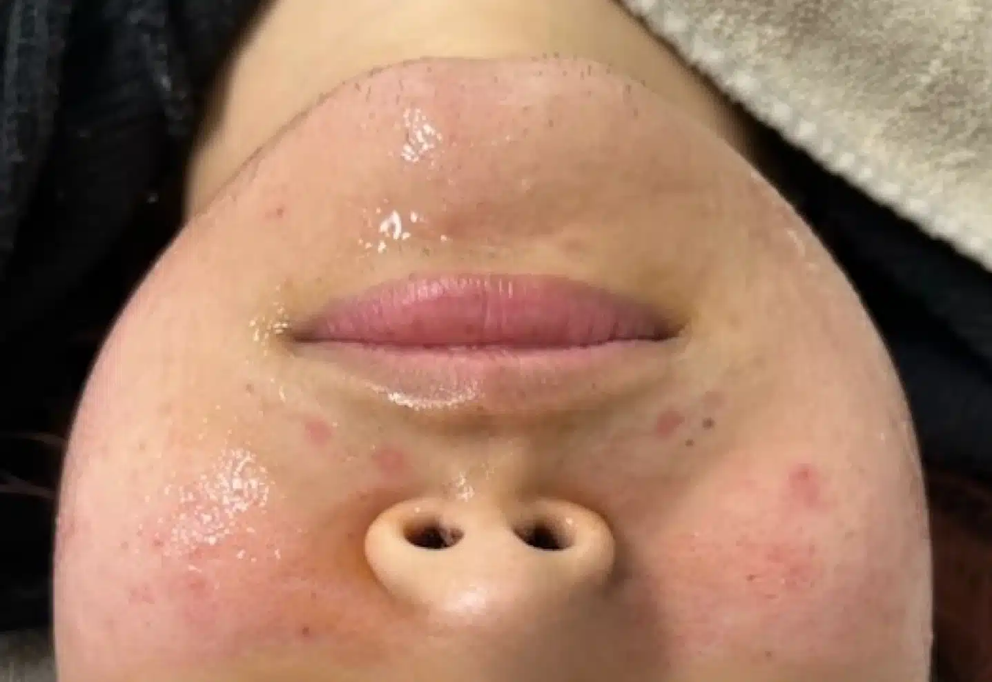 Lipid Mask