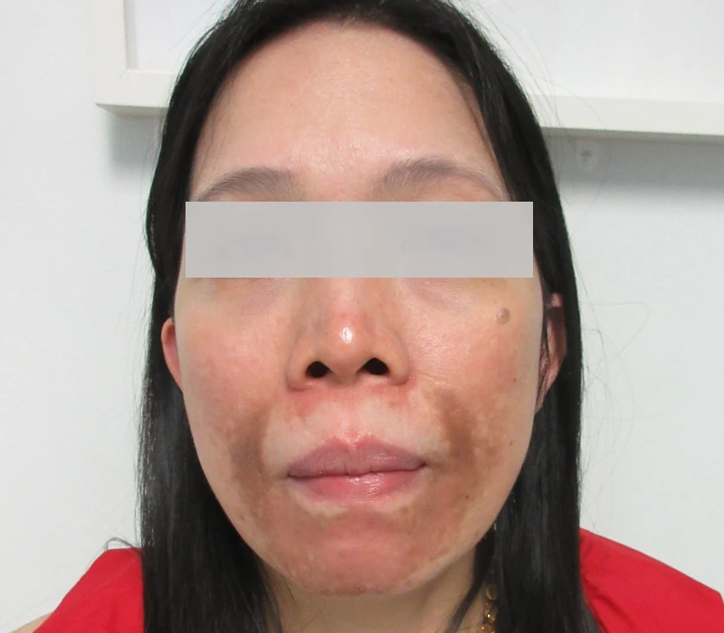 Before Microneedling with Exosomes