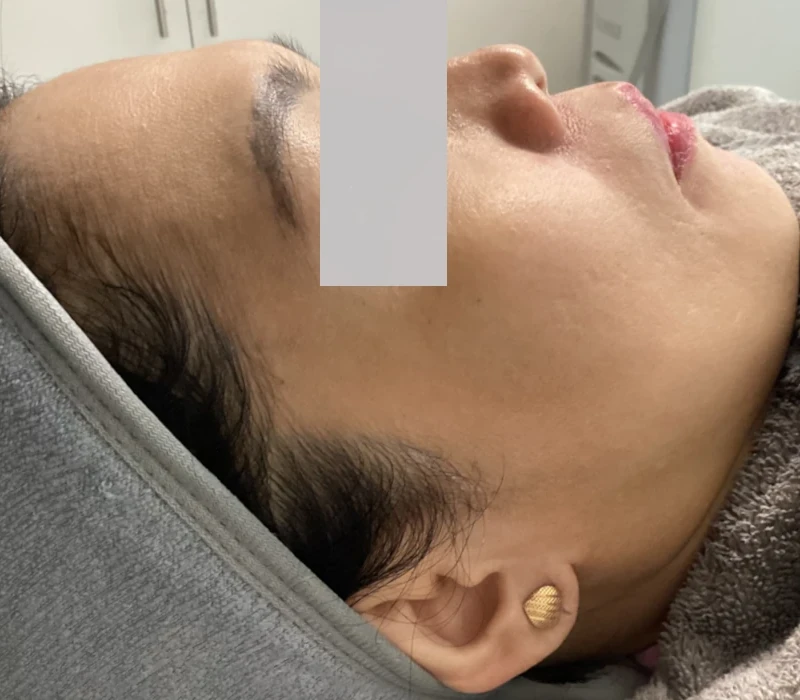 After Microneedling with Exosomes