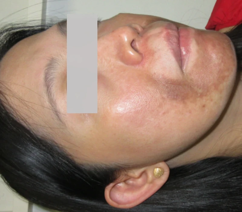 Before Microneedling with Exosomes