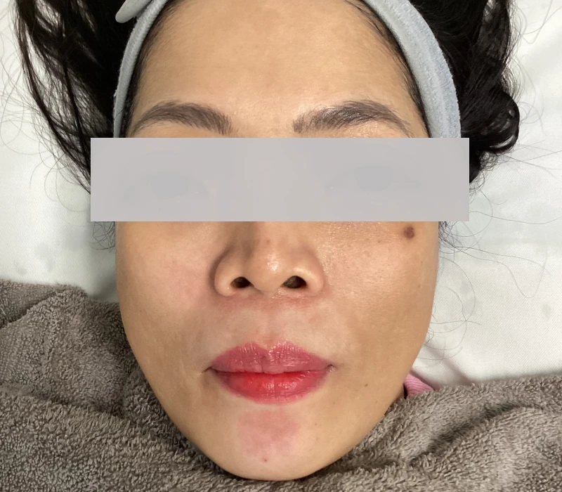 After Microneedling with Exosomes