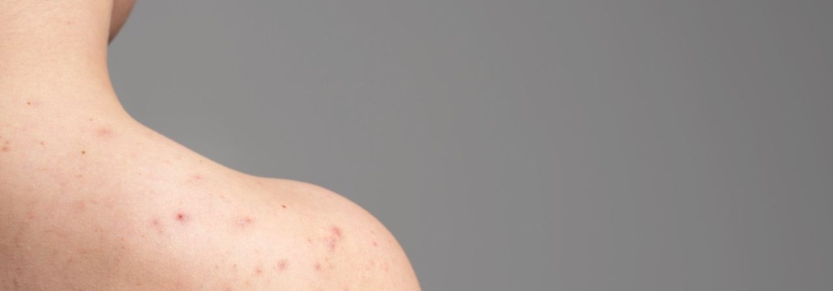 Woman with back acne visible on shoulders and upper back