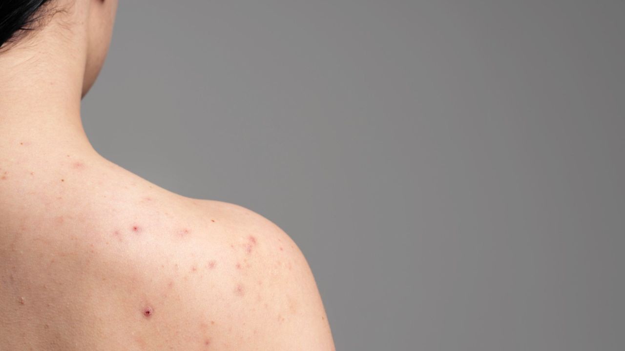 Woman with back acne visible on shoulders and upper back